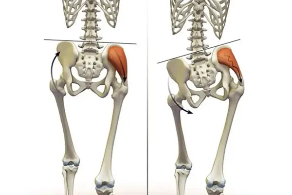 انحراف جانبی لگن