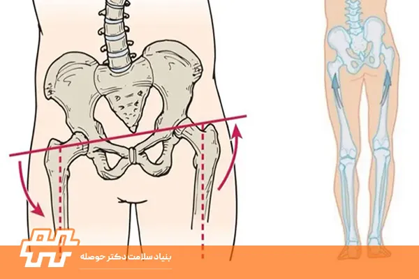 تفاوت انحراف جانبی لگن با چرخش لگن