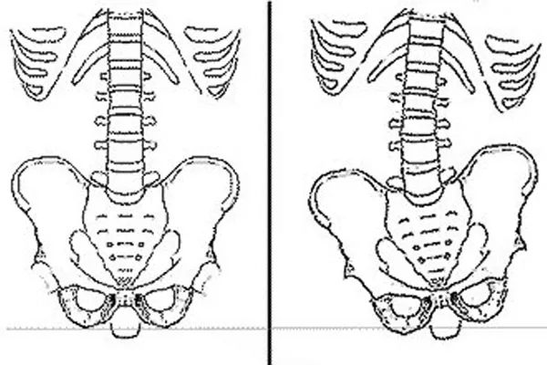 تفاوت انحراف جانبی لگن با چرخش لگن