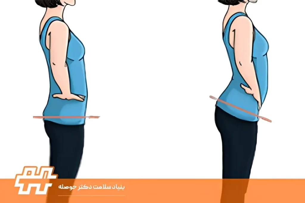 اصلاح تیلت خلفی لگن