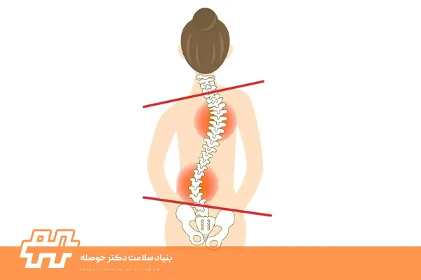 درمان اسکولیوز بدون جراحی