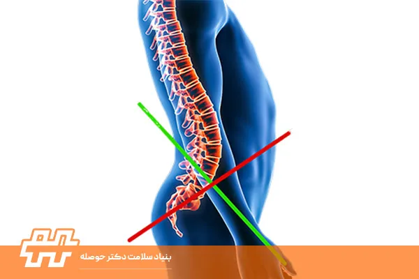 سندرم صلیب پایین