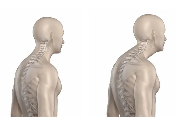 علت کیفوز یا گوژپشتی