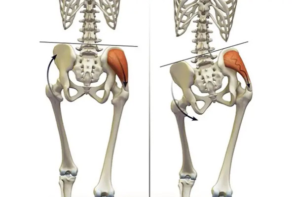 اصلاح انحراف جانبی لگن