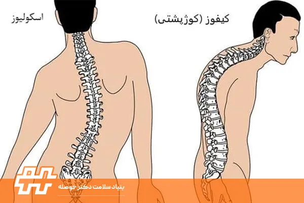 اسکولیوز