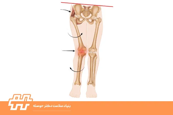 چطور بفهمیم Internal Knee Rotation داریم؟
