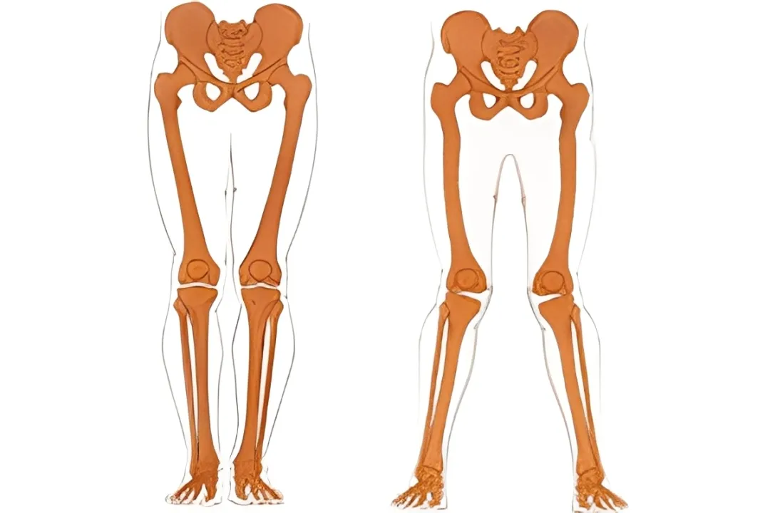 چطور بفهمیم Internal Knee Rotation داریم؟