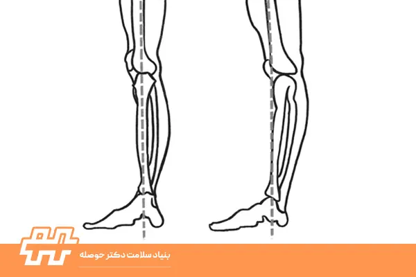 هایپر اکستنشن زانو