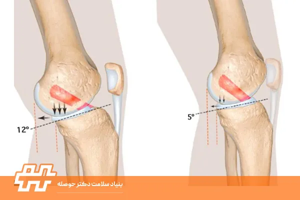 علت جلوآمدگی زانو