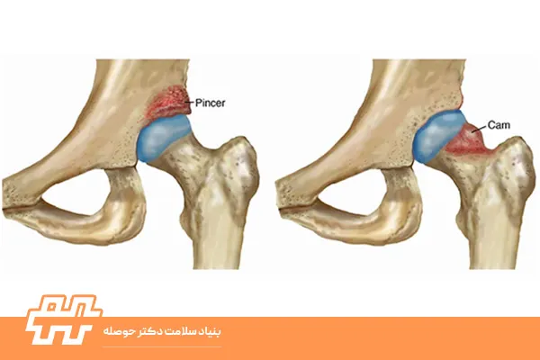 چرخش داخلی فمور