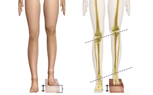 فرق پای کوتاه واقعی با خمیدگی لگن