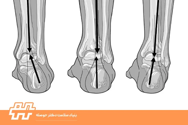 علل انحراف مچ پا