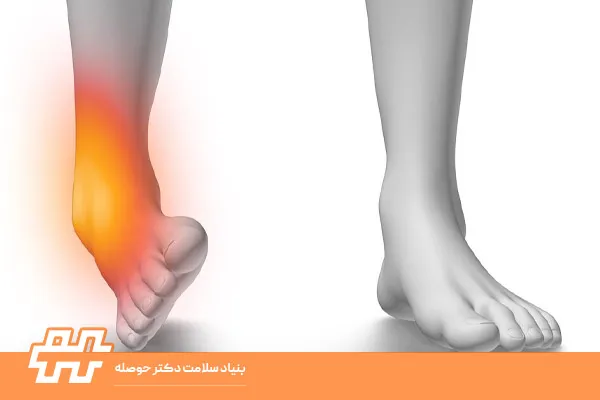 انحراف مچ پا