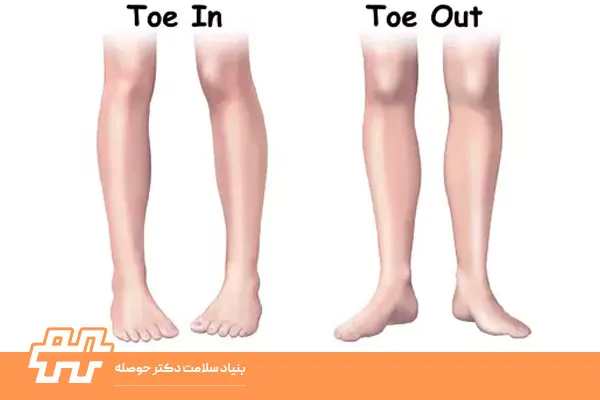 تفاوت چرخش داخلی و خارجی زانو ها