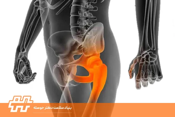 تقویت چرخش خارجی فمور