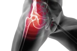 تقویت چرخش خارجی فمور