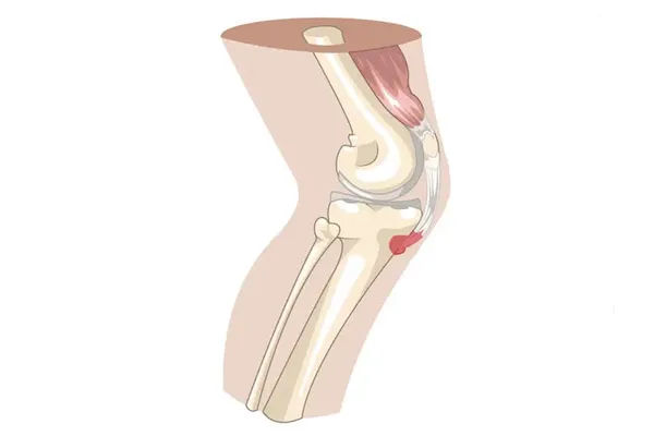 تمرینات مؤثر برای کنترل جلوآمدگی زانو و تقویت ثبات زانو