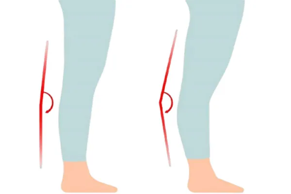 زانو بیش از حد صاف