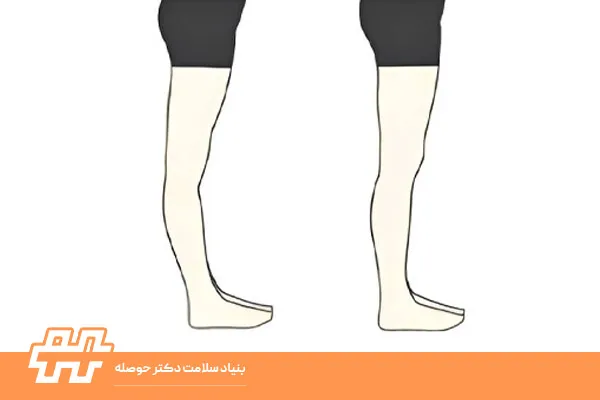 زانوهای بیش از حد صاف