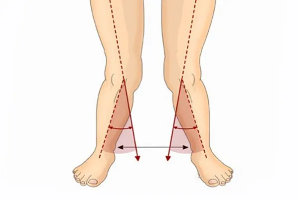 اصلاح زانو ضربدری