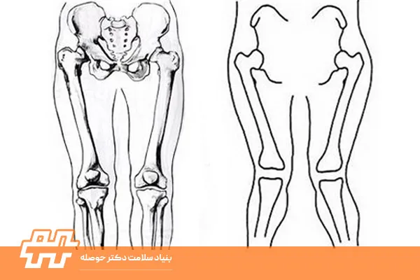اصلاح زانو ضربدری