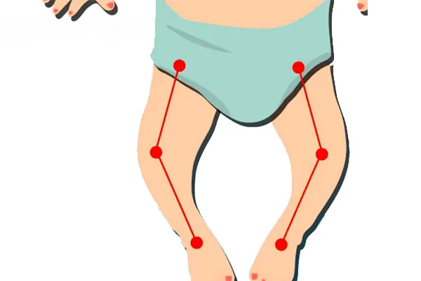 زانو پرانتزی