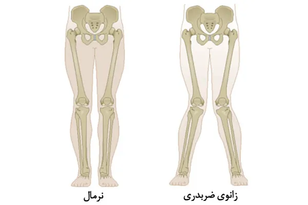 زانو ضربدری