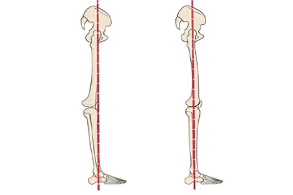 زانوهای بیش از حد صاف