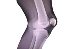 علت جلوآمدگی زانو