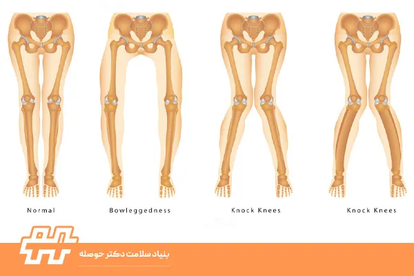 علت چرخش داخلی فمور