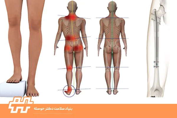 فرق پای کوتاه واقعی با خمیدگی لگن