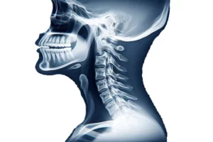 هایپرلوردوزیست گردن