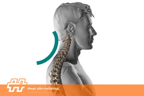 هایپرلوردوز گردنی
