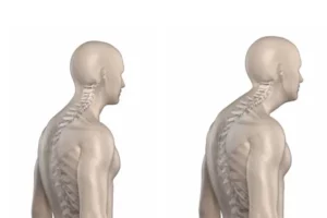 هایپرلوردوز گردنی