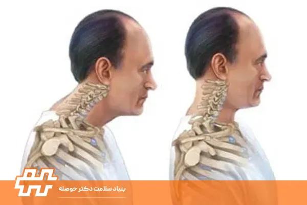 هایپر لوردوزیست