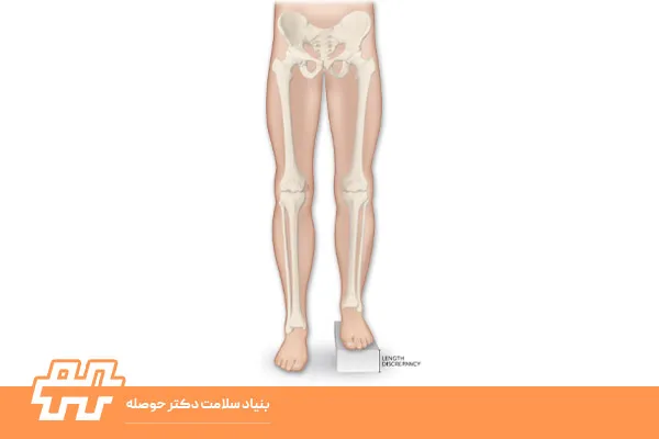 پای کوتاه‌تر در کودکان و بزرگسالان