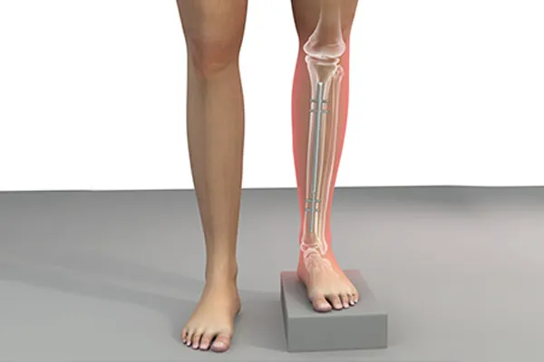  پای کوتاه‌تر در کودکان و بزرگسالان