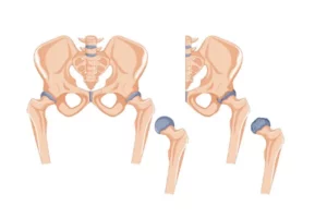 استخوان فمور