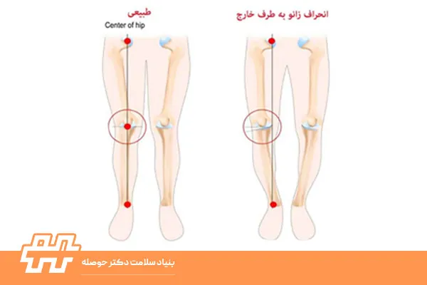 چرخش خارجی طبیعی زانو