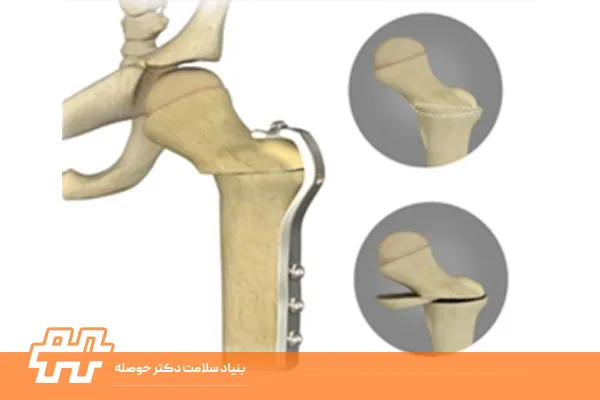 چرخش خارجی فمور را در خانه تست کرد