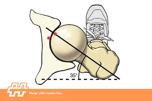 چرخش داخلی فمور