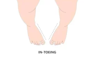 In‑toeing