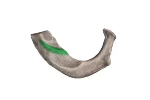 معرفی عضله اسکالن قدامی