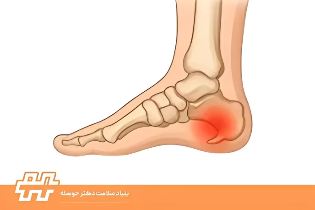 انحراف پاشنه