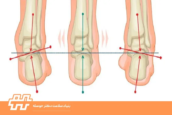 انحراف پاشنه