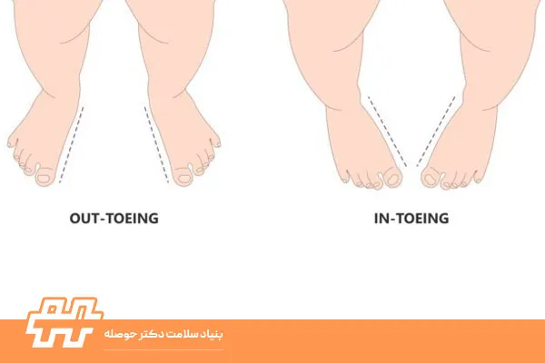 مقایسه Out‑toeing و In‑toeing