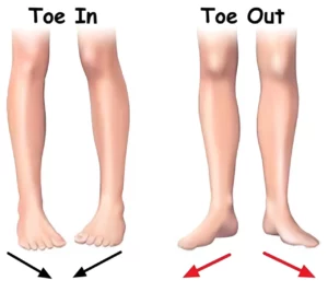 مقایسه Out‑toeing و In‑toeing