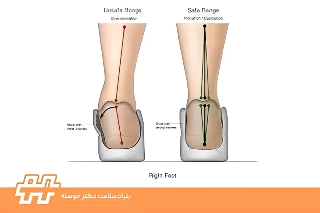 انحراف مچ پا