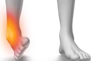 عوارض انحراف مچ پا بر زانو