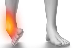 انحراف پاشنه